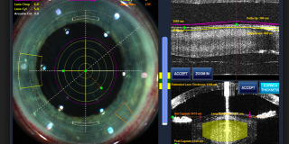 chirurgia della cataratta