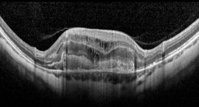 Iniezioni Intravitreali Maculopatie